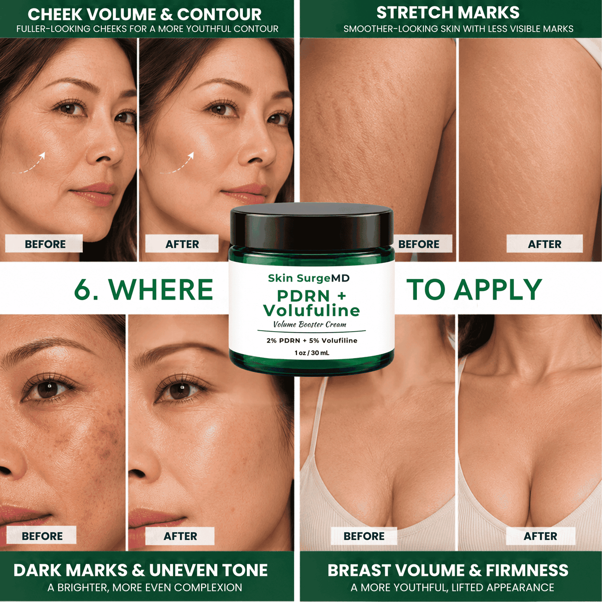 2% pdrn 100% volufiline before after, volume booster. volufiline before and after,  to reduce stretch marks on thighs and improve breast volume.