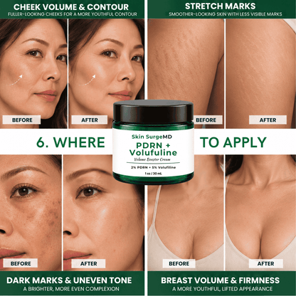 2% pdrn 100% volufiline before after, volume booster. volufiline before and after,  to reduce stretch marks on thighs and improve breast volume.