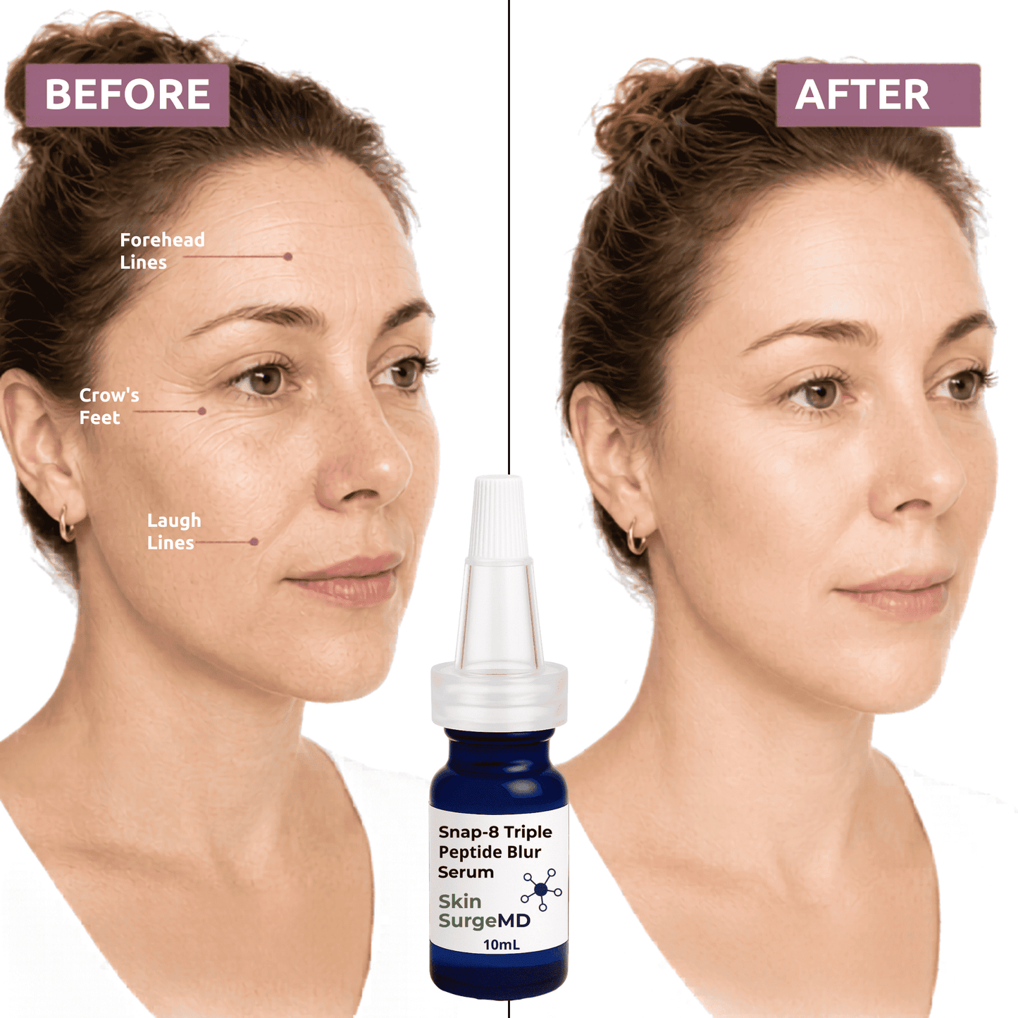 Snap-8 peptide Before and after comparison of a woman's face with crow's feet, laugh lines, and forehead wrinkles. A 10ml bottle of Snap-8 Triple Peptide Blur Serum