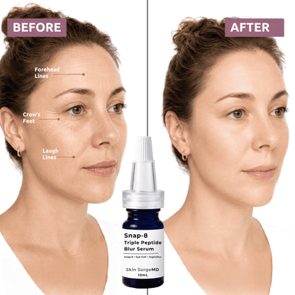 Snap-8 peptide Before and after comparison of a woman's face with crow's feet, laugh lines, and forehead wrinkles. A 10ml bottle of Snap-8 Triple Peptide Blur Serum