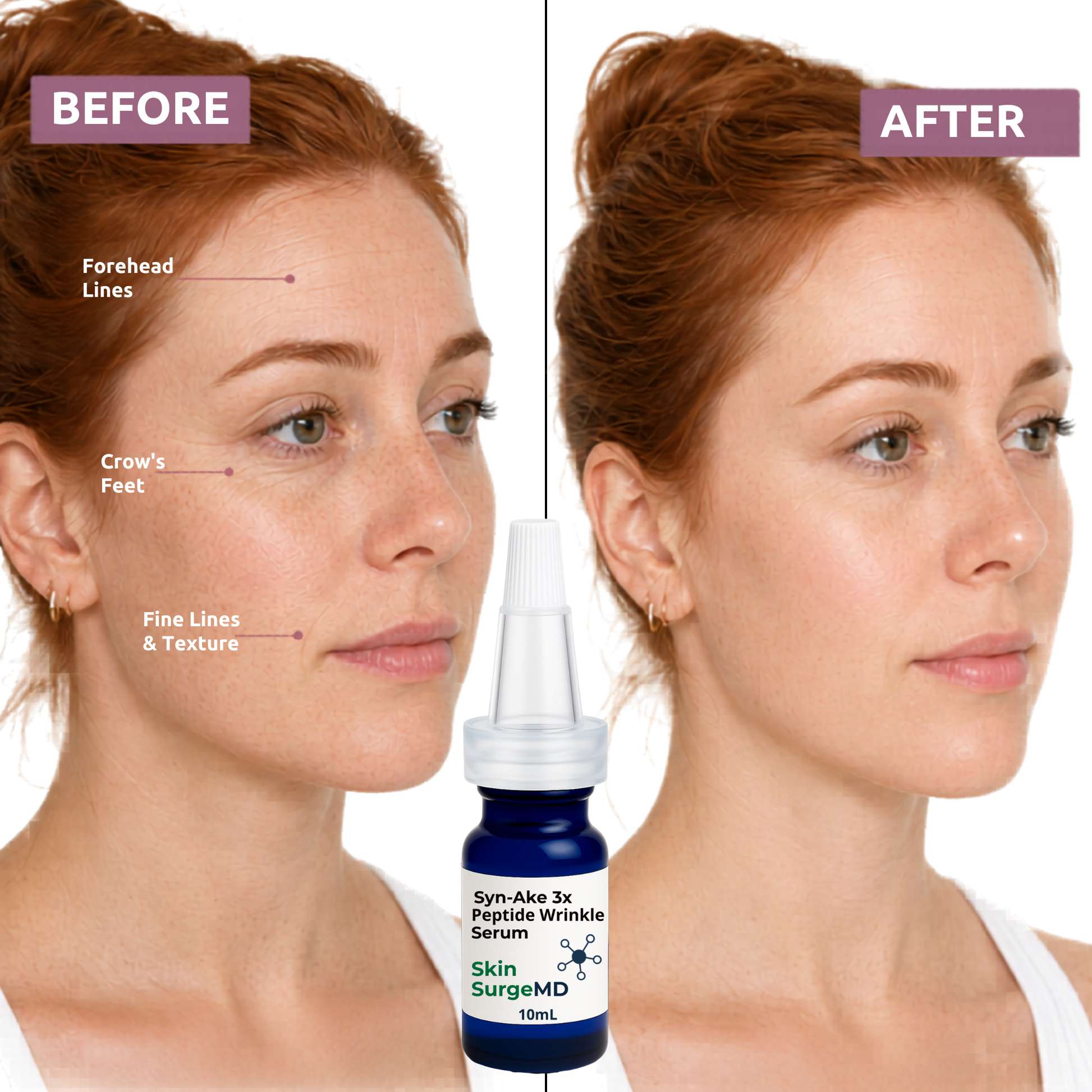 Before and after comparison of a fine lines and wrinkles woman's face with a bottle of Skin SurgeMD serum.