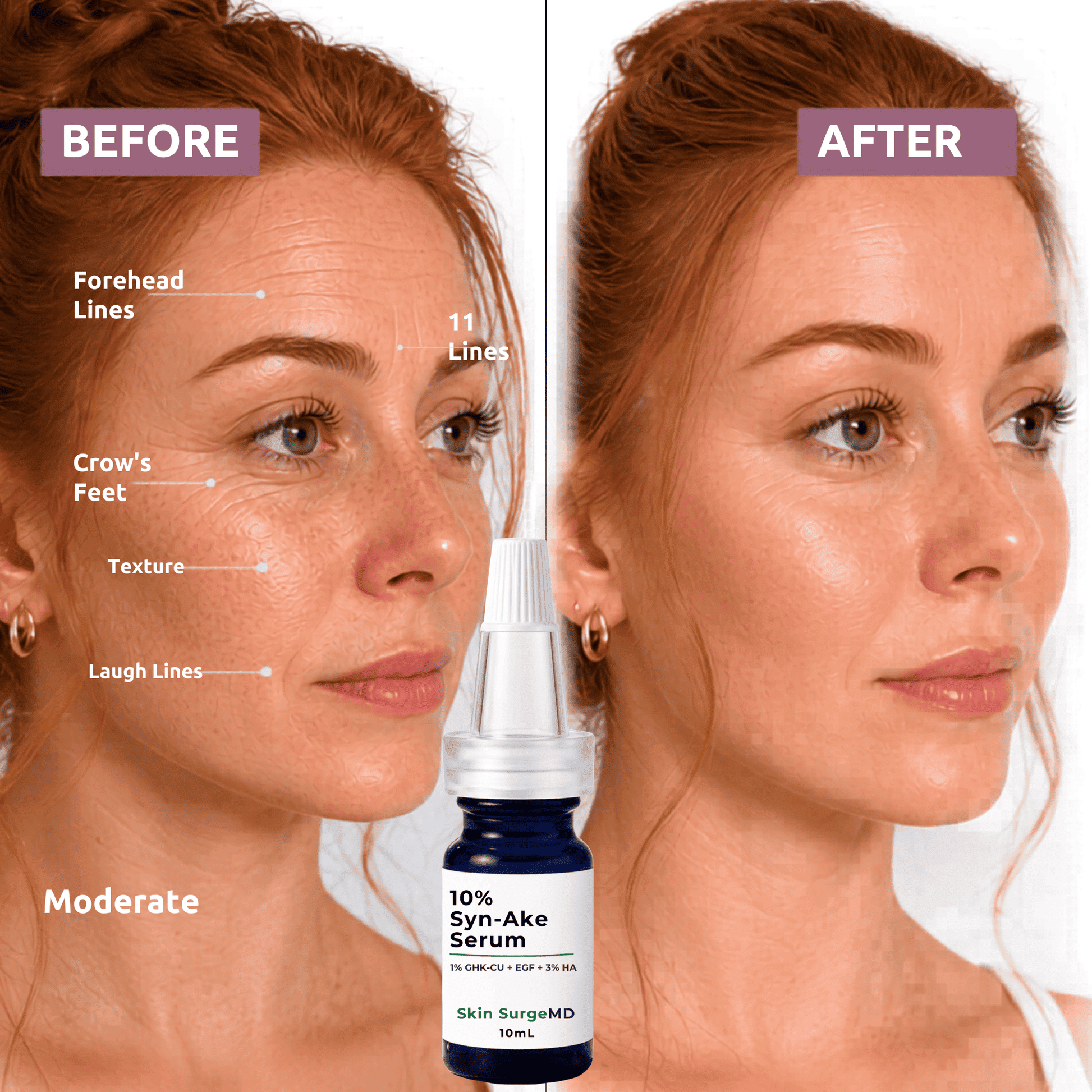 Before and after skincare comparison showing a woman's face with text labels for forehead lines, crow's feet, texture, and laugh lines, alongside a bottle of Skin SurgeMD 10% Syn-Ake Serum.