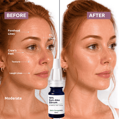 Before and after skincare comparison showing a woman's face with text labels for forehead lines, crow's feet, texture, and laugh lines, alongside a bottle of Skin SurgeMD 10% Syn-Ake Serum.