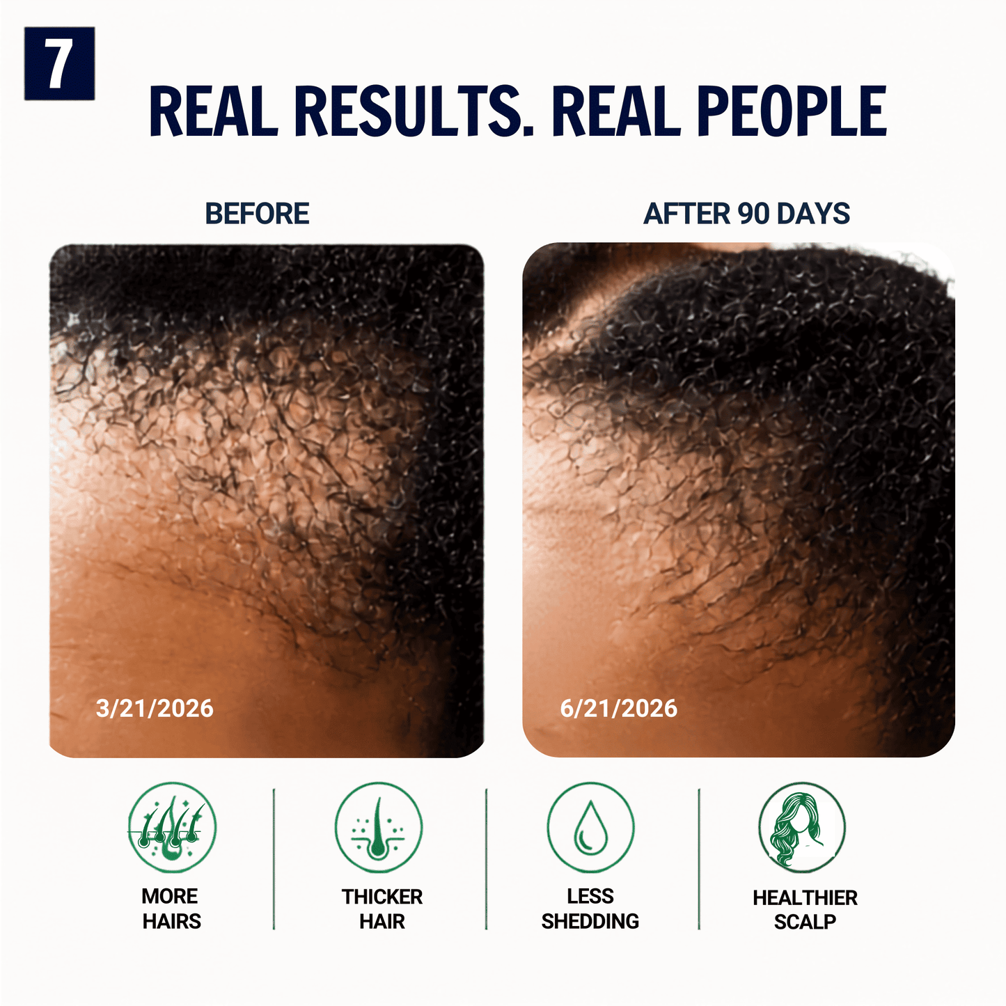 A before-and-after comparison graphic for hair growth results, showing close-up scalp photos labeled 'BEFORE' and 'AFTER 90 DAYS' with dates and icons for 'More Hairs', 'Thicker Hair', 'Less Shedding', and 'Healthier Scalp'.