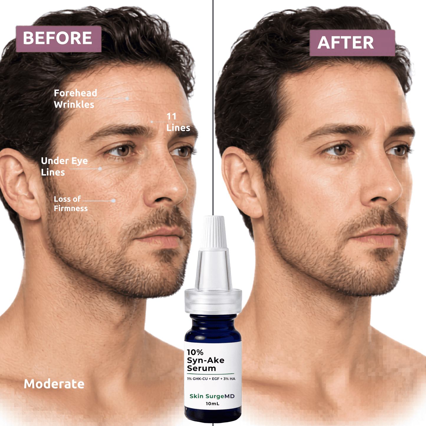 Before and after comparison of a man's face with a bottle of 10% Syn-Ake Serum Skin SurgeMD serum.