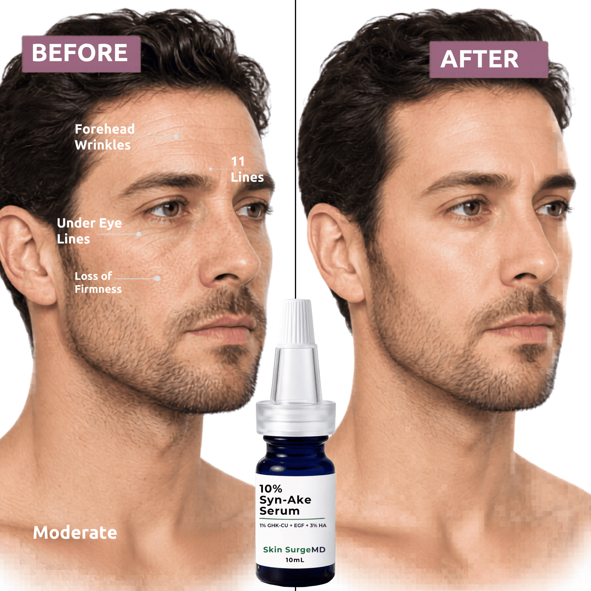 Before and after comparison of a man's face with a bottle of 10% Syn-Ake Serum Skin SurgeMD serum.