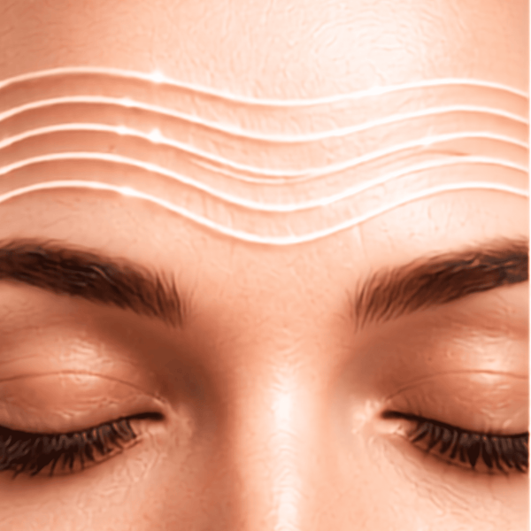 Close-up of a person's forehead wrinkles with several white curved lines drawn across the brow area, above closed eyes and eyebrows for Syn-Ake peptide.